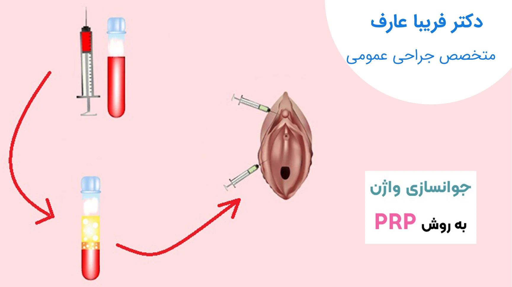 تنگ کردن واژن با روش پی آر پی (پلاسمای غنی از پلاکت)
